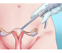 Каковы последствия операции по удалению миомы матки?