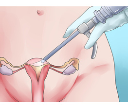 Каковы последствия операции по удалению миомы матки?